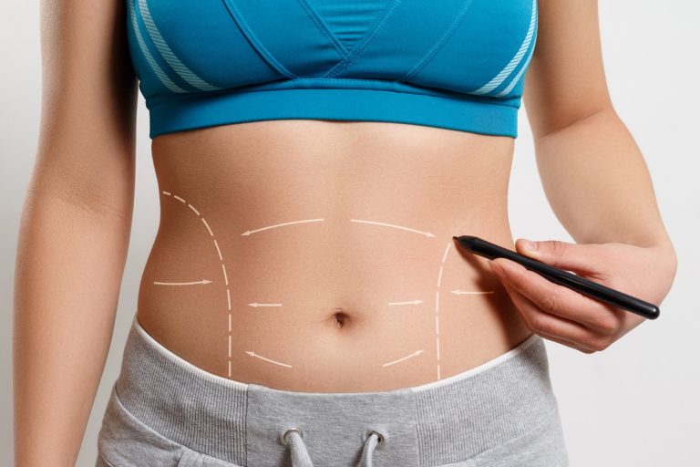 How to Prepare for Your Tummy Tuck Surgery in Washington DC